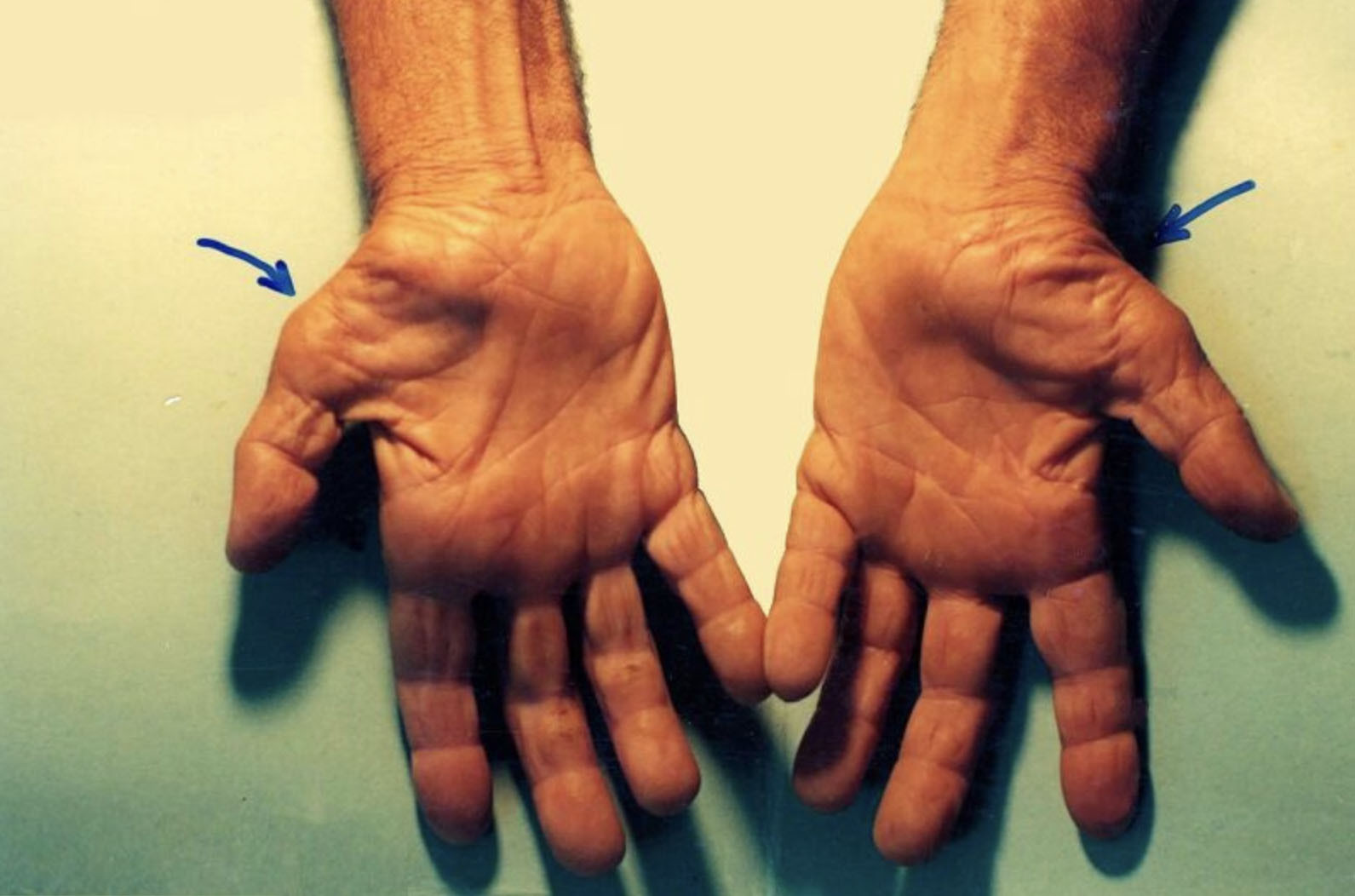 Atrophy seen in advanced Carpal Tunnel Syndrome