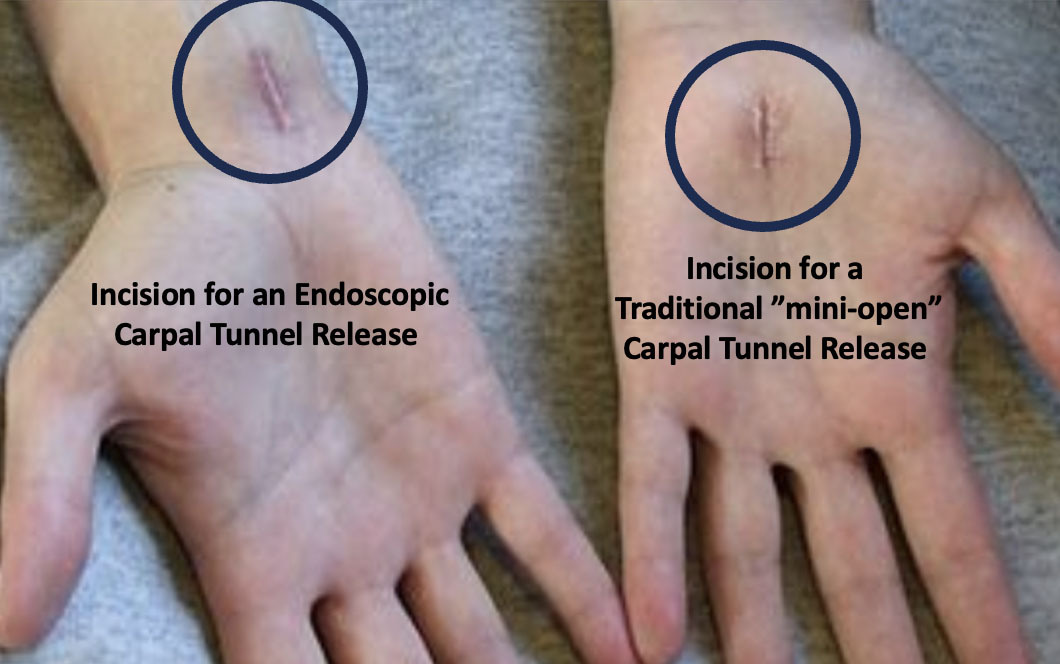 Carpal Tunnel Incisions with Open and Endoscopic surgery.